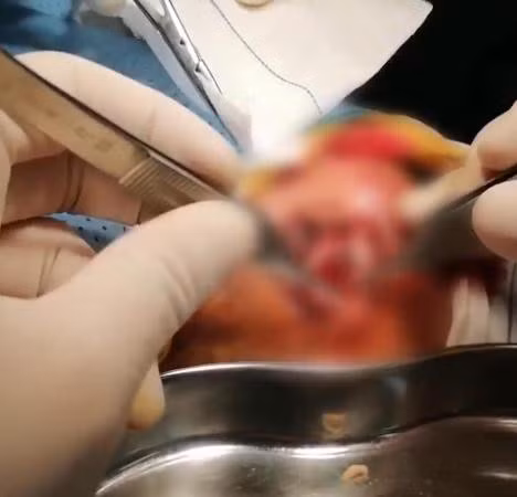 Nhiều bác sĩ đã cùng nhau tiến hành loại bỏ ký sinh trùng ra khỏi vết thương của cụ bà