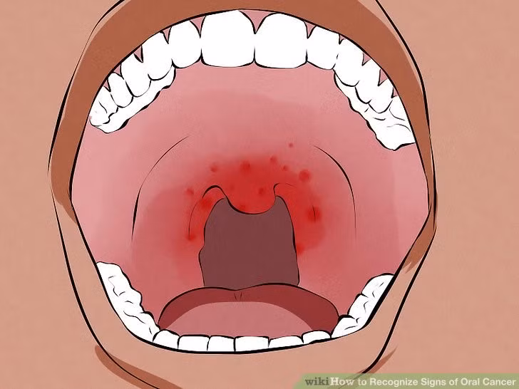 Ô nhiễm không khí liên quan đến nguy cơ ung thư miệng