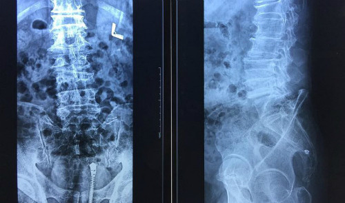 Cột sống lưng của bệnh nhân bị biến dạng. Ảnh: BVCC