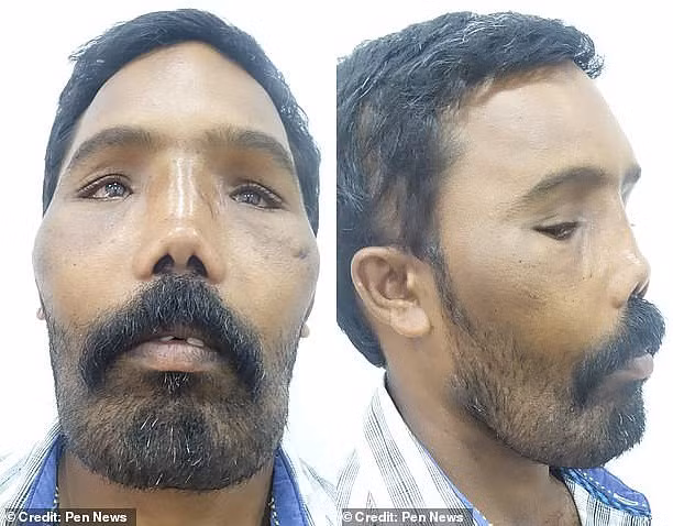 Người đàn ông mang khuôn mặt sư tử suốt 23 năm vì bệnh siêu hiếm, thế giới mới có vài trường hợp - Hình 2