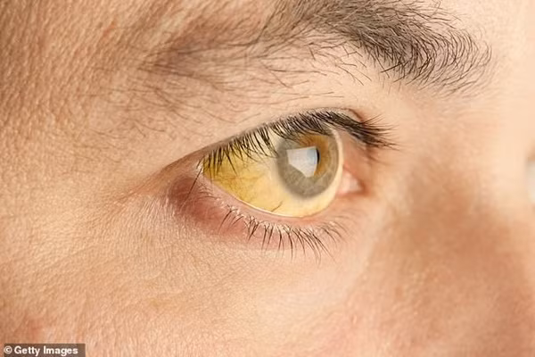 Mắt vàng có liên quan đến bệnh về gan.