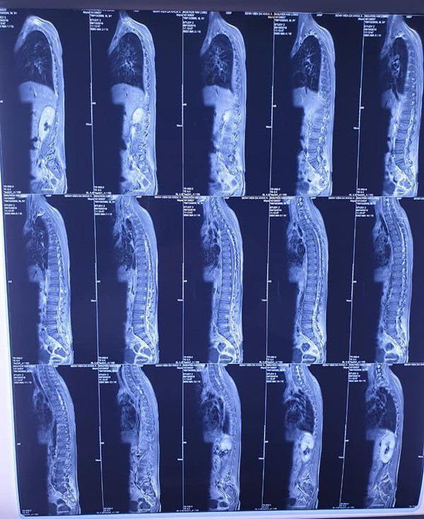 Chỉ nốt mụn nhỏ cha mẹ không ngờ con trai 9 tuổi mắc bệnh nguy hiểm Chỉ nốt mụn nhỏ cha mẹ không ngờ con trai 9 tuổi mắc bệnh nguy hiểm