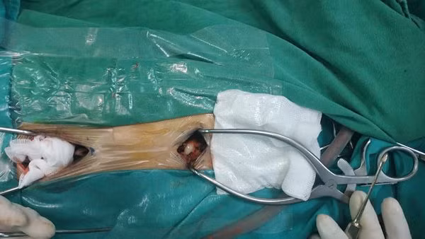 Chỉ nốt mụn nhỏ cha mẹ không ngờ con trai 9 tuổi mắc bệnh nguy hiểm