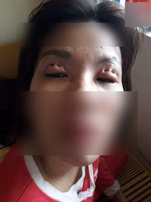 Bỏ tiền cắt mí, mẹ trẻ cay đắng nhận lại đôi mắt “biến dạng” như phim kinh dị ảnh 2 Đôi mí sưng húp, nhăn nhúm khiến