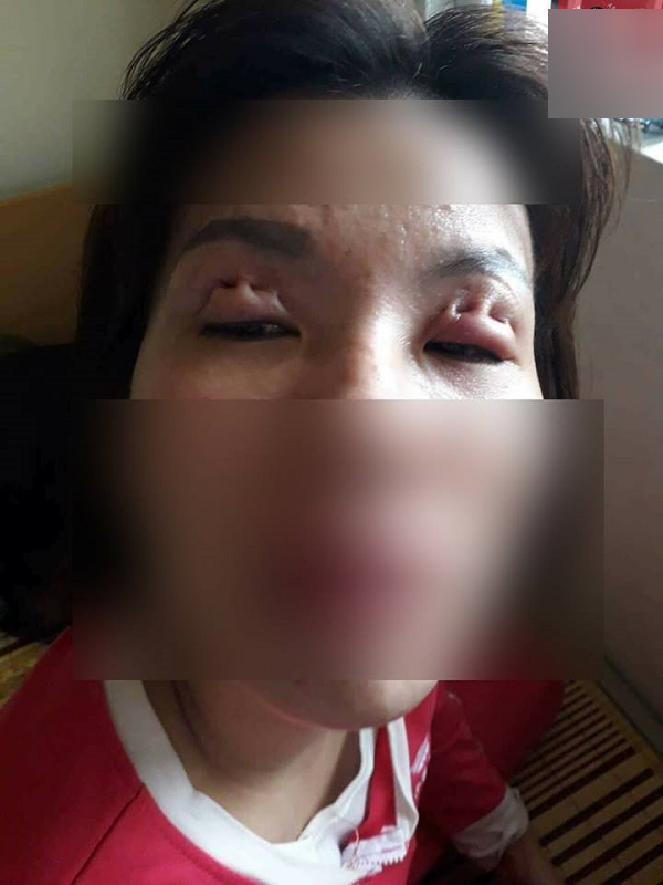 Bỏ tiền cắt mí, mẹ trẻ cay đắng nhận lại đôi mắt “biến dạng” như phim kinh dị ảnh 2 Đôi mí sưng húp, nhăn nhúm khiến