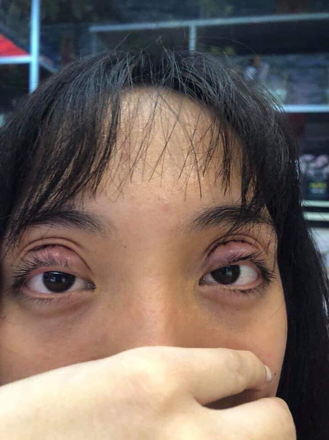 Bỏ tiền cắt mí, mẹ trẻ cay đắng nhận lại đôi mắt “biến dạng” như phim kinh dị ảnh 1 Nhìn đôi mắt của cô nàng mà ai nấy cũng thương cảm thay.
