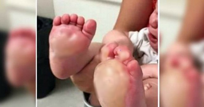 Mỹ: Tức giận vì bé 6 tháng tuổi quấy khóc, bảo mẫu nhẫn tâm nhúng 2 bàn chân bé vào chảo dầu sôi