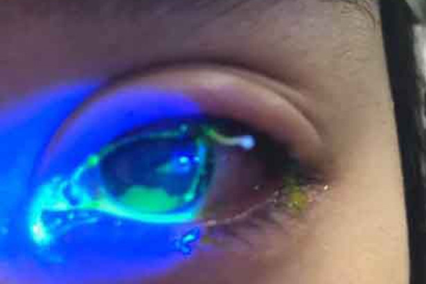 xam mi mat lam dep nhieu nguoi bi bong giac mac nguy co bi mu