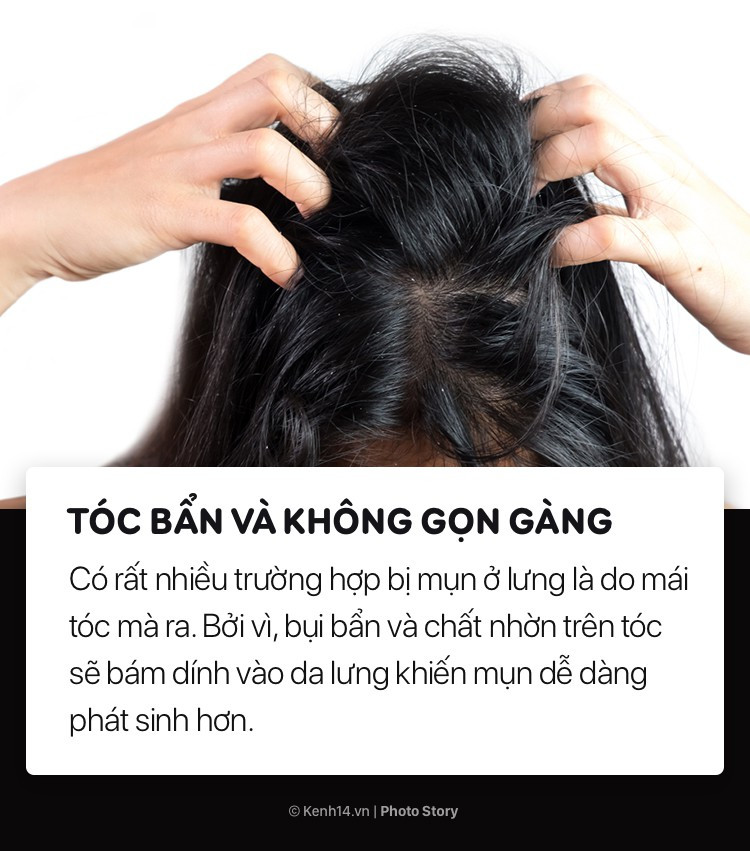 Đừng hỏi vì sao lưng nổi nhiều mụn nếu bạn thường có những thói quen này - Ảnh 7. Đừng hỏi vì sao lưng nổi nhiều mụn nếu bạn thường có những thói quen này - Ảnh 7.