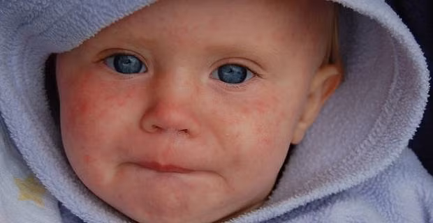 10 điều cần biết để phòng tránh sởi