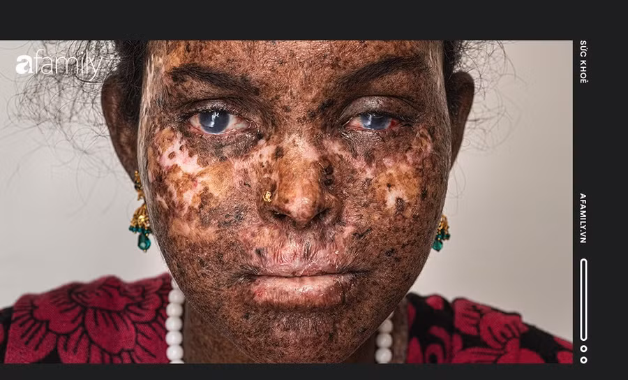 Hậu quả hôn nhân cận huyết: Những đứa trẻ chết dần chết mòn bởi… ánh nắng mặt trời