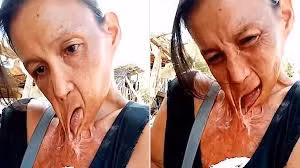 Chuyện đau lòng khó tin về người phụ nữ bị miệng dính trên ngực sau hỏa hoạn suốt 15 năm