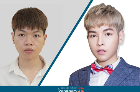 Ca sĩ Đức Phúc sở hữu ngoại hình điển trai sau thẩm mỹ. Ca sĩ Đức Phúc sở hữu ngoại hình điển trai sau thẩm mỹ.