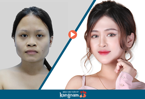 Ca sĩ phòng trà Phương Tuyền trước và sau thẩm mỹ. Ca sĩ phòng trà Phương Tuyền trước và sau thẩm mỹ.