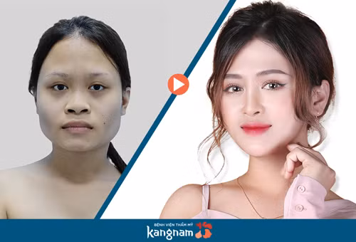 Ca sĩ phòng trà Phương Tuyền trước và sau thẩm mỹ.