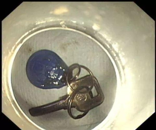 Đau ngực dữ dội, nam thanh niên sốc với thứ mình nuốt phải