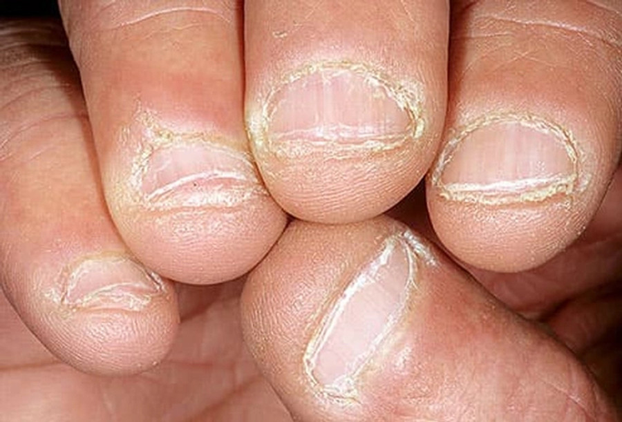 Cắn móng tay là thói quen của nhiều người, nhưng trong một số trường hợp, đó là dấu hiệu của sự lo lắng dai dẳng, tốt nhất nên được điều trị. (Ảnh: ITN) Cắn móng tay là thói quen của nhiều người, nhưng trong một số trường hợp, đó là dấu hiệu của sự lo lắng dai dẳng, tốt nhất nên được điều trị. (Ảnh: ITN)