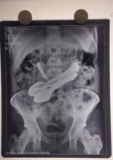 Ảnh chụp X-quang từ bụng của người đàn ông.