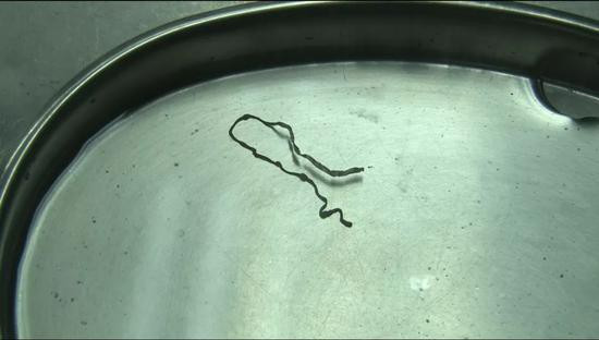 Bác sĩ phát hoảng khi lôi con ký sinh trùng dài 9cm từ não của cô gái 16 tuổi: Cảnh báo cẩn trọng từ món ăn nhiều người thích ảnh 1