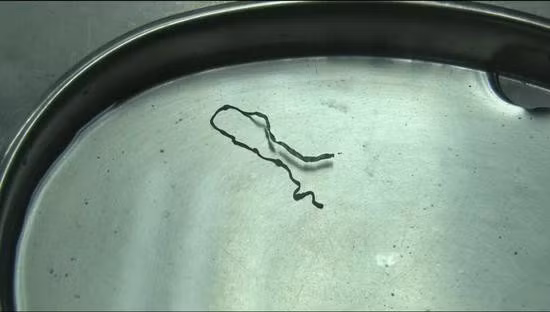 Bác sĩ phát hoảng khi lôi con ký sinh trùng dài 9cm từ não của cô gái 16 tuổi: Cảnh báo cẩn trọng từ món ăn nhiều người thích ảnh 1