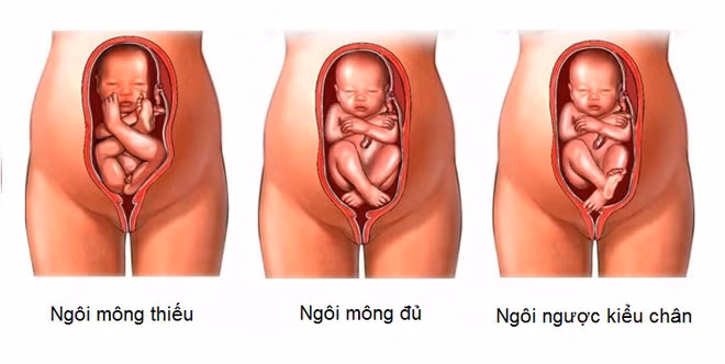 Những điều mẹ bầu cần biết khi được chẩn đoán có ngôi thai ngược - Ảnh 1.