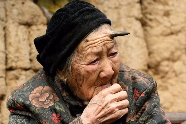 Từ khi bước sang tuổi 100, cụ bà bỗng mọc sừng trên đầu