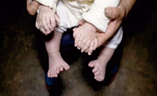 Những ca thừa bộ phận cơ thể kỳ quặc trên thế giới ảnh 1