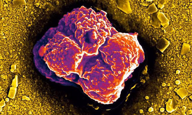 Tại sao tế bào ung thư lan rất nhanh khắp cơ thể?