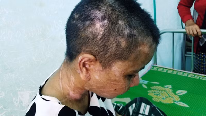 Y Nhiêu bị vô số vết thương trên cơ thể sau khi nhận nhiều trận tra trấn của Nga Vọc.