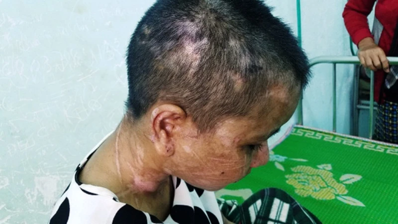Y Nhiêu bị vô số vết thương trên cơ thể sau khi nhận nhiều trận tra trấn của Nga Vọc.