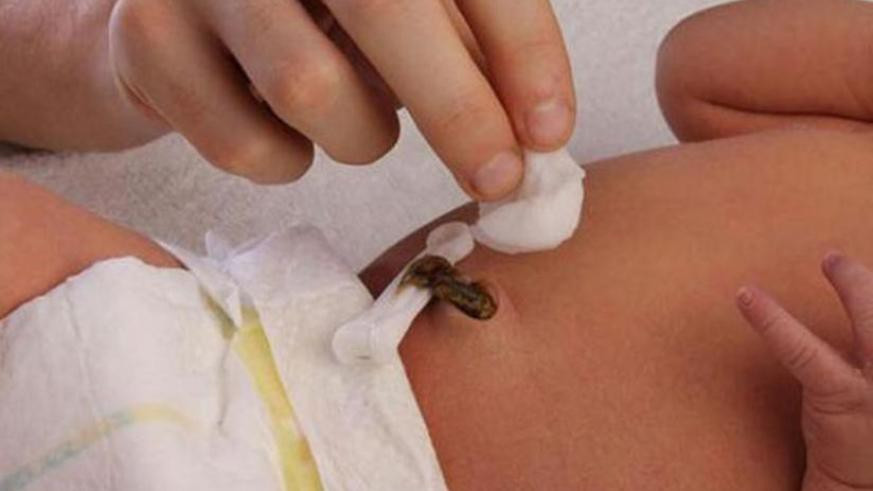 1442779661umbilical-stump 1442779661umbilical-stump