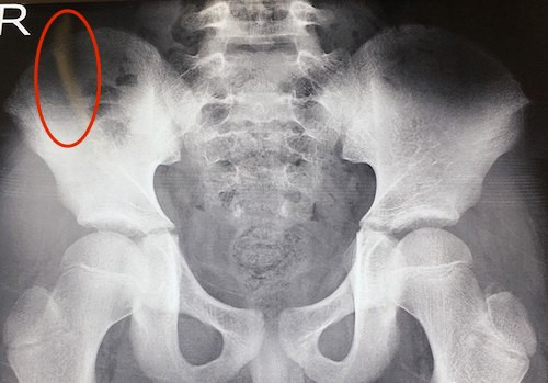 Hình ảnh que tăm (khoanh đỏ) khi chụp phim.