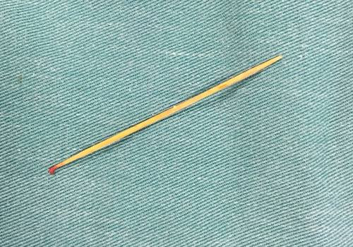 Que tăm đã găm trong mông bé trai mà bác sĩ bệnh viện Chấn thương chỉnh hình Nghệ An gắp ra.