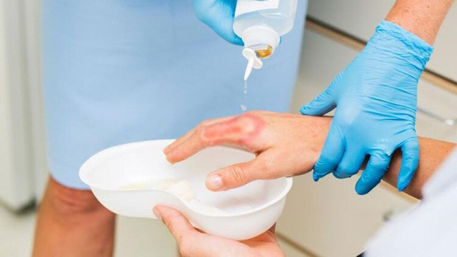 Những việc tuyệt đối không nên làm khi bị bỏng - Ảnh 2. Những việc tuyệt đối không nên làm khi bị bỏng - Ảnh 2.