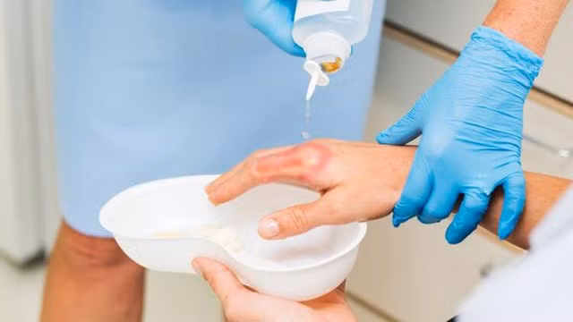 Những việc tuyệt đối không nên làm khi bị bỏng - Ảnh 2.