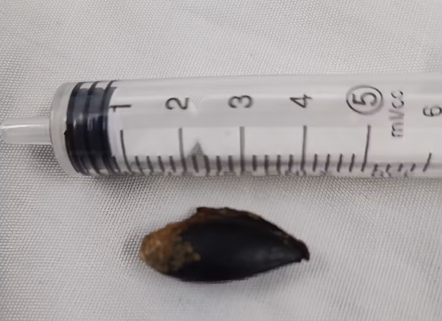 Hạt sabochê (hồng xiêm) nằm trong phổi bệnh nhân suốt 26 năm.