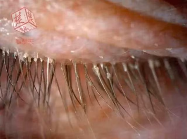 Sau 2 năm chịu đựng, cô Xu mới đến khám bác sĩ nhãn khoa