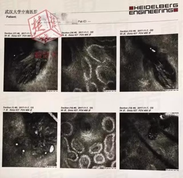 Lông mi và mí mắt của cô dính lại với nhau vì số lượng ký sinh trùng khổng lồ