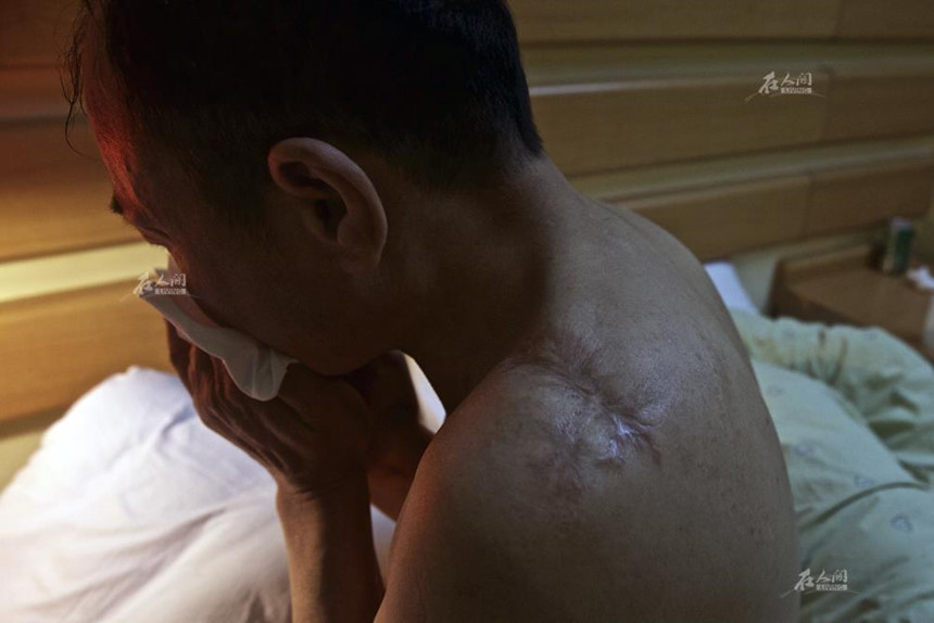 Những vết sẹo trên cơ thể của Nghiêu Kiến Vân, hậu quả của cờ gian bạc lận. Ảnh:Ifeng. ‘Vua co bac’ Trung Quoc va noi dau mat doi chan, 3 ngon tay vi do den hinh anh 2