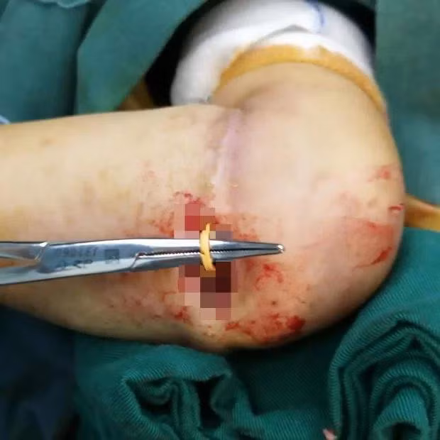 Sợi dây chun đã ăn hẳn vào trong da tay bé