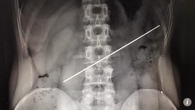 Thanh thép dài 20cm trong dạ dày của bệnh nhân.