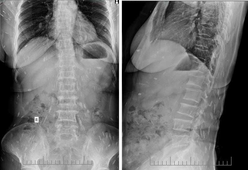 Đau thắt lưng, đi khám ra sán lá gan lớn sinh sôi khắp cơ thể - ảnh 1