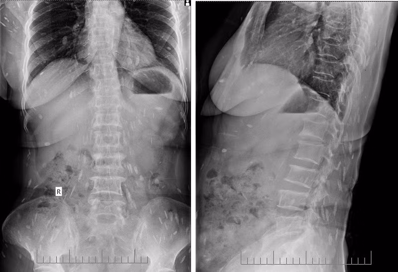 Đau thắt lưng, đi khám ra sán lá gan lớn sinh sôi khắp cơ thể - ảnh 1