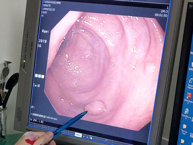 Chỉ vì thói quen ăn uống này mà 7 người trong 1 gia đình Đài Loan đối mặt với nguy cơ ung thư đại trực tràng - Ảnh 1. Chỉ vì thói quen ăn uống này mà 7 người trong 1 gia đình Đài Loan đối mặt với nguy cơ ung thư đại trực tràng - Ảnh 1.