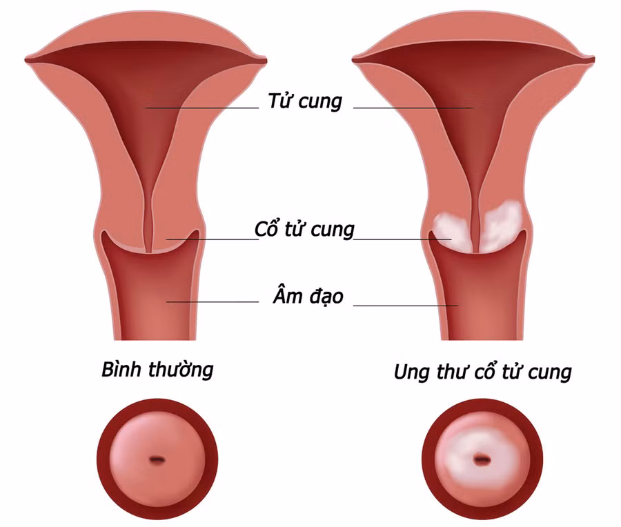 Với việc bơm dung dịch vào âm đạo, phụ nữ đang đối mặt hàng loạt hệ luỵ liên quan đến sức khoẻ. Gần nhất là các tổn thương liên quan âm đạo và tử cung