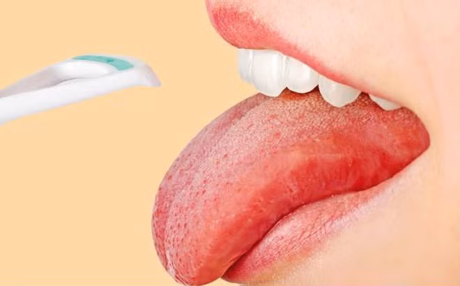 Thấy lưỡi xuất hiện dấu hiệu này, hãy cảnh giác vì cơ thể đang báo động bệnh nguy hiểm