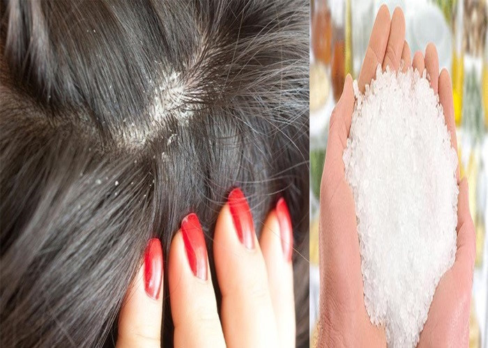 Đổ 1 muỗng này vào dầu gội, tóc óng mượt bồng bềnh, không còn bóng dáng của gàu ảnh 2 he-lo-cach-tri-gau-bang-muoi-tieu-diet-hieu-qua-hang-trieu-vi-khuan-phunutoday