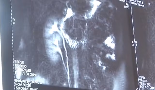 Phát hiện có 3 quả thận, đồng ý cho bớt 1 quả - 2