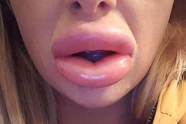 Cô gái có đôi môi như 2 chiếc xúc xích gắn trên mặt chỉ vì tiêm môi dạo - Ảnh 1.