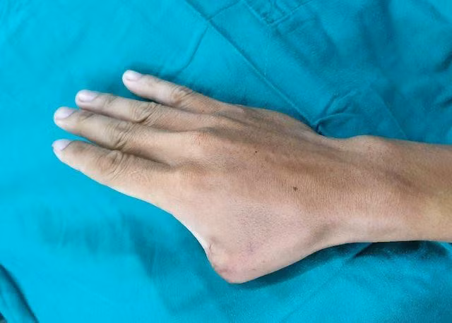 Lấy ngón chân tạo thành ngón tay cái cho bệnh nhân